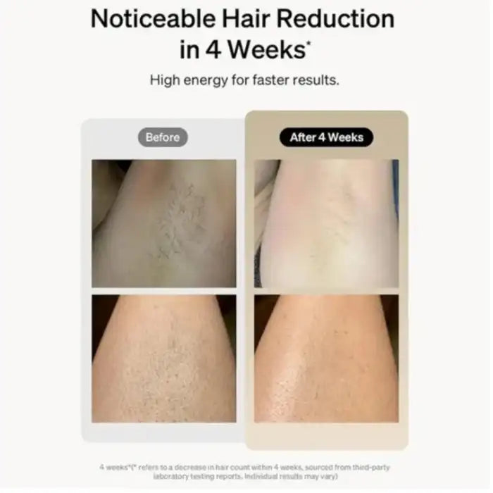 Laser epilator hair removal before and after 4 weeks showing clear hair reduction results