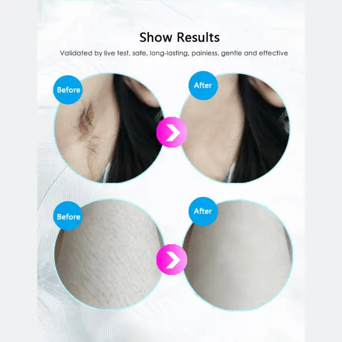 Laser hair remover before and after photos showing smooth underarm and leg results after treatment