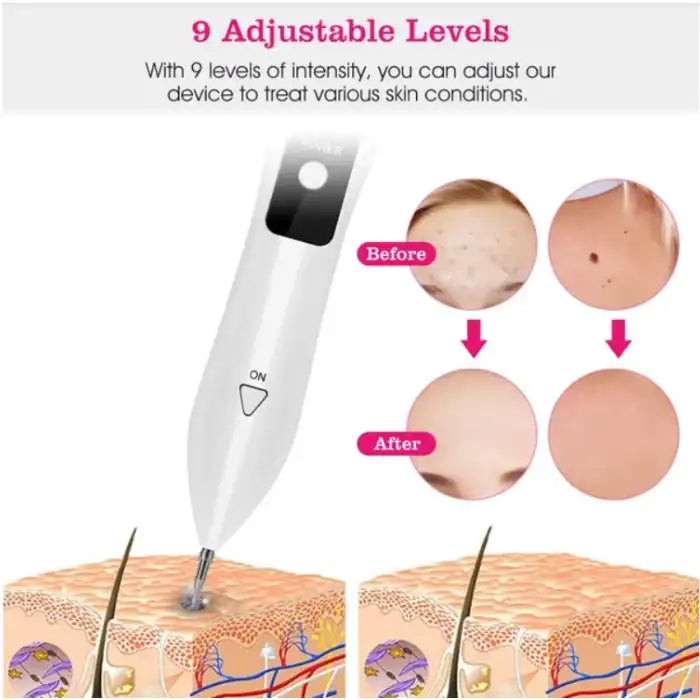 Skin Tag Remover device demonstrating before and after results on moles and acne spots.